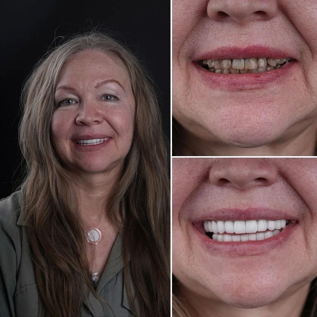 Kaksi hymyilevää naista, yksi koko kuvassa ja toinen lähikuvina, jotka esittelevät hampaiden kunnon ennen ja jälkeen hammaslääkärin hoitoa.