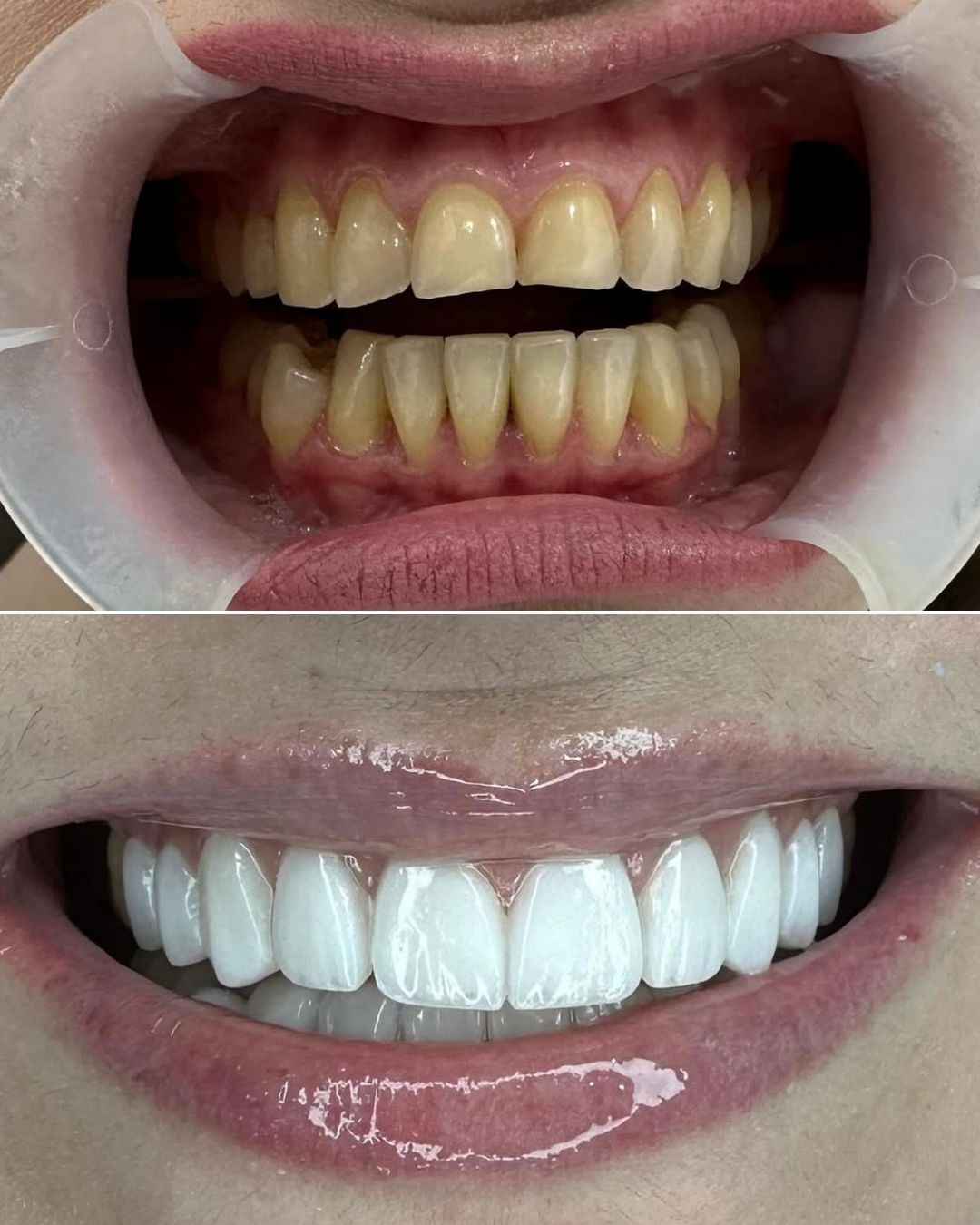 Ensin nähdään ihmisen irtorentävät hampaat, jotka ovat kellertävät ja epäsiistit, ja sen jälkeen hymyilevä henkilö, jonka hampaat ovat valkoiset ja esteettiset.