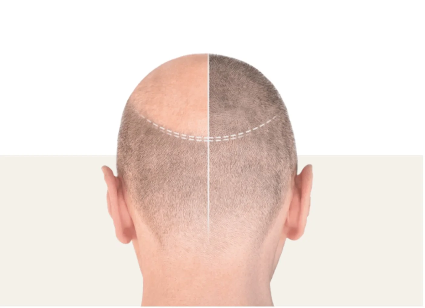 Kuvassa ihmisen pään takaosa, jossa on osittain kalju ja osittain hiukseton alue, jotka on jaettu vertikaalisesti. Yläpuolisen kaljun osan hiukseton alue on merkitty kuvassa valkoisella viivalla.