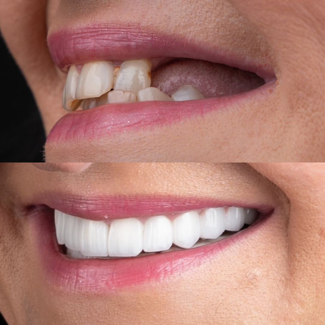 Kuvassa on ihmisen suu, jossa on kaksi osaa: yläosassa alun perin huonossa kunnossa tahratut hampaat ja alhaalla hyväkuntoiset, valkoiset hampaat.