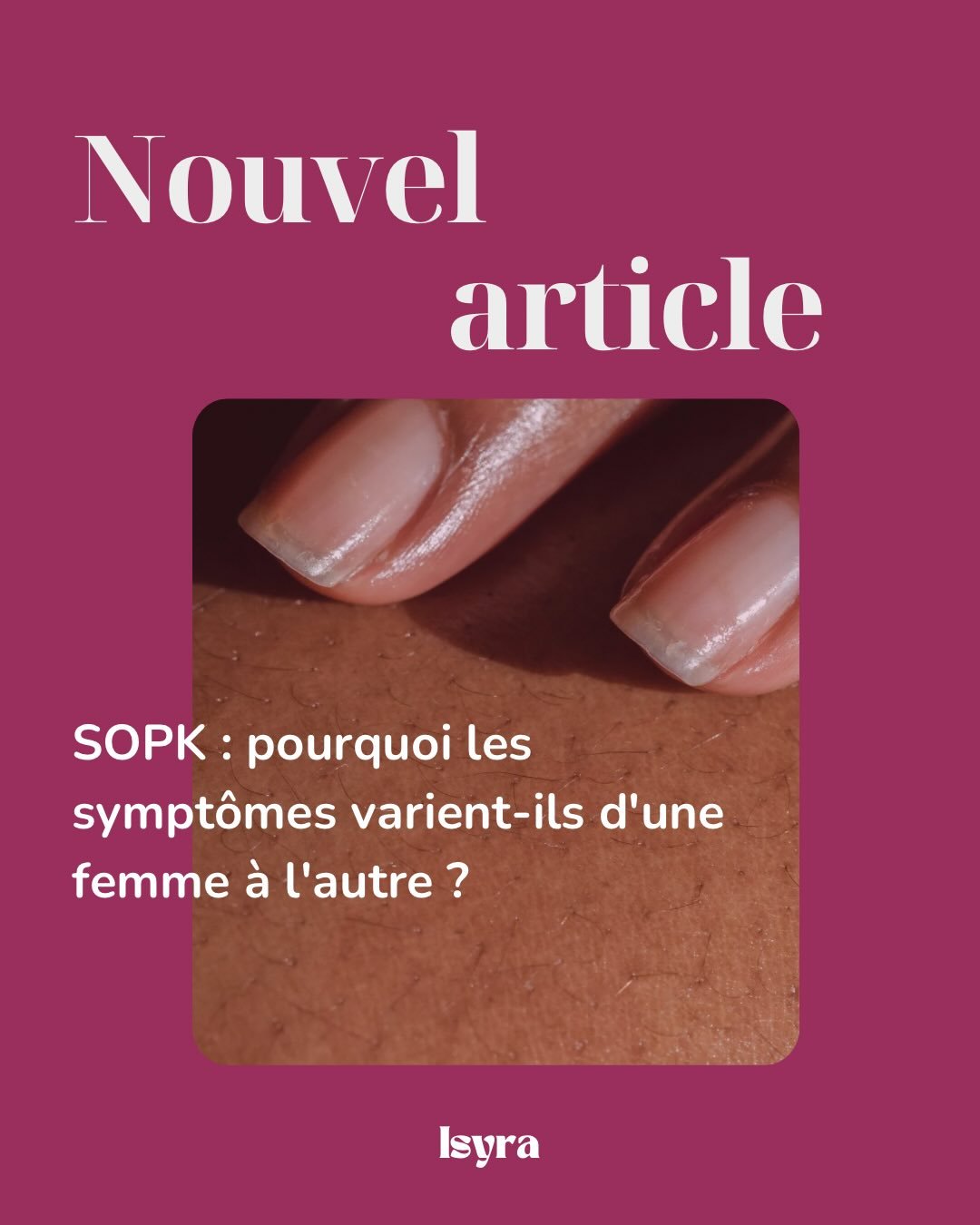 Le SOPK ne ressemble pas &agrave; la m&ecirc;me chose chez toutes les femmes.
L&rsquo;une a des cycles irr&eacute;guliers. L&rsquo;autre une acn&eacute; persistante. Une troisi&egrave;me des bilans &laquo;&nbsp;normaux&nbsp;&raquo; pendant des ann&ea