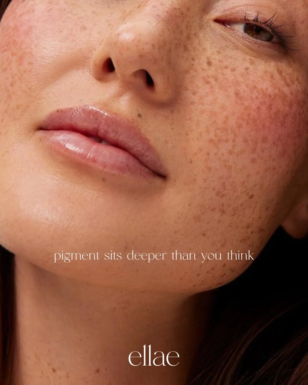 Pigmentation isn&rsquo;t only what you see at first glance, it often develops in the deeper layers of the skin.

At Ellae we use evidence based modalities such as BBL laser, skin needling &amp; targeted brightening boosters to address pigment at mult