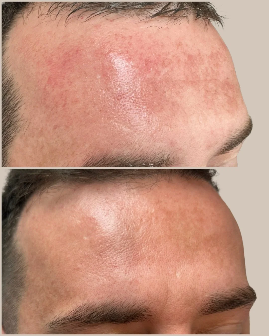 Highlighting this visible change in skin clarity following our client&rsquo;s BBL laser session.

This treatment was customised to target areas of redness, sun related pigmentation and overall uneven tone. Following treatment the skin appears calmer,