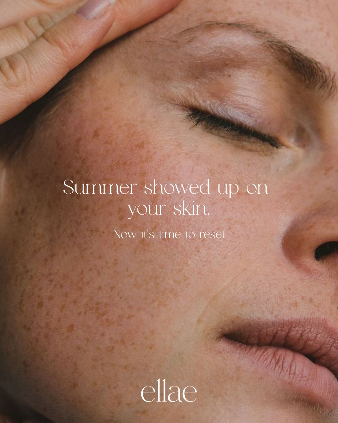 Summer has a way of staying on the skin.

Pigment that lingers, redness that won&rsquo;t quite settle &amp; uneven tone that makeup keeps covering.

BBL is one of our go to light treatments for addressing visible sun related skin changes and supporti