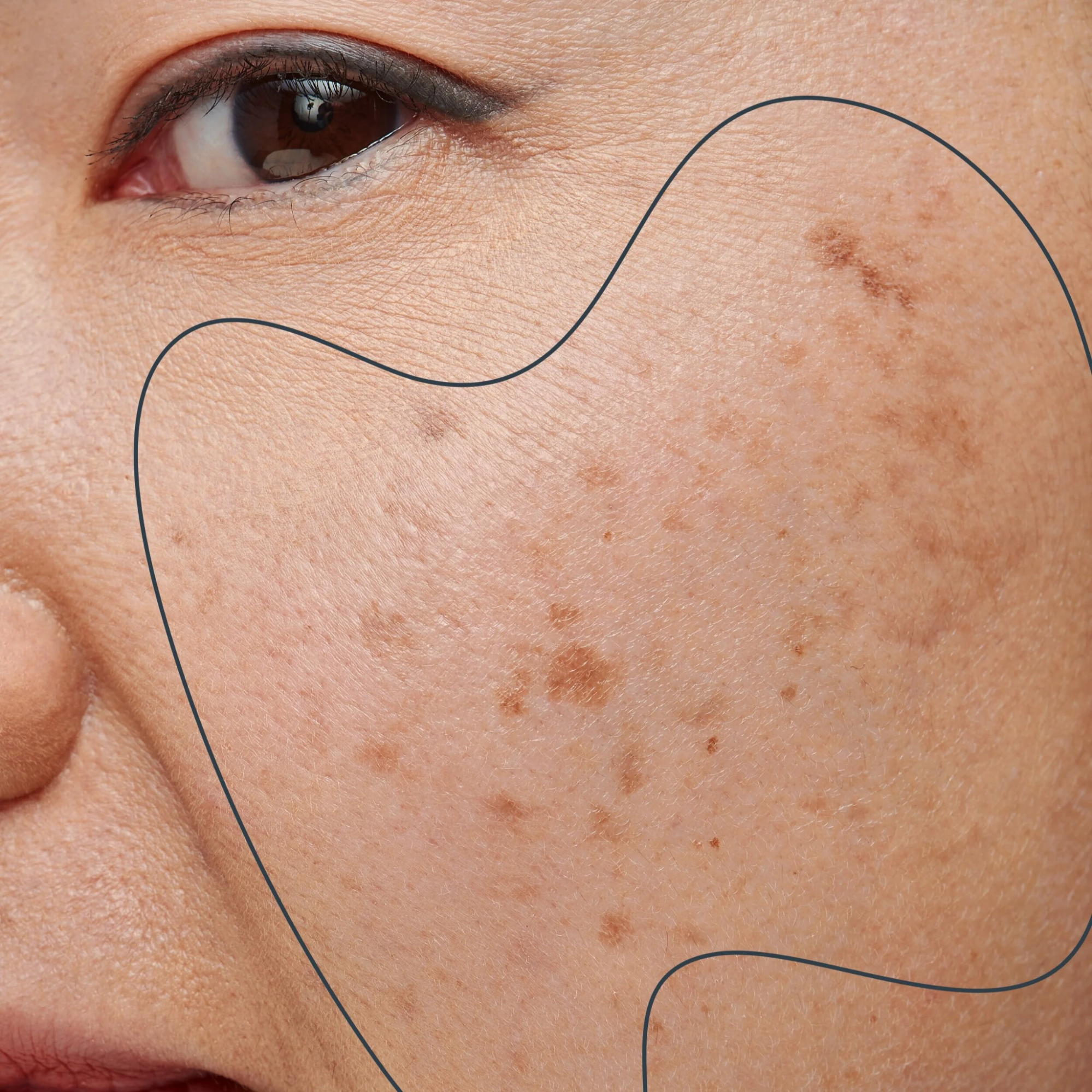 Why Pigmentation Often Worsens During Summer — And What Helps
