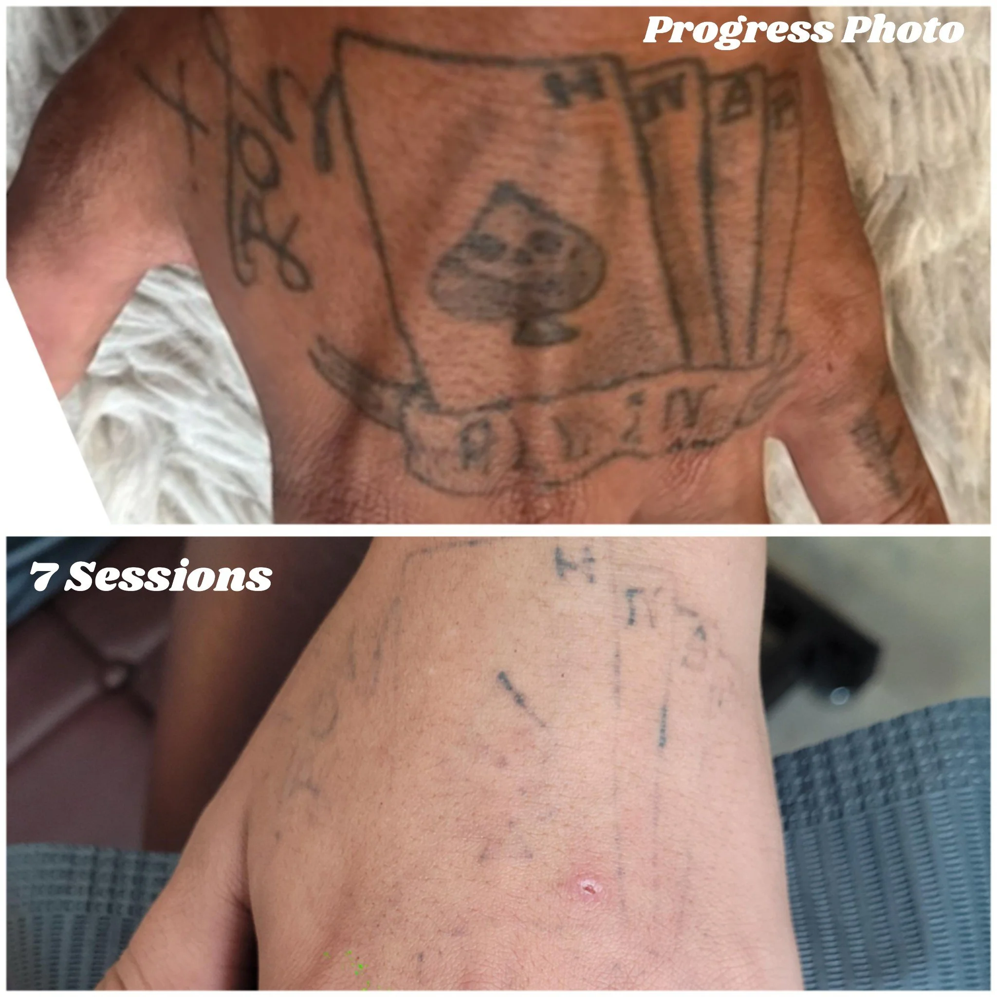 Comparison of a tattoo on a person's upper chest before and after 7 tattoo removal sessions.
