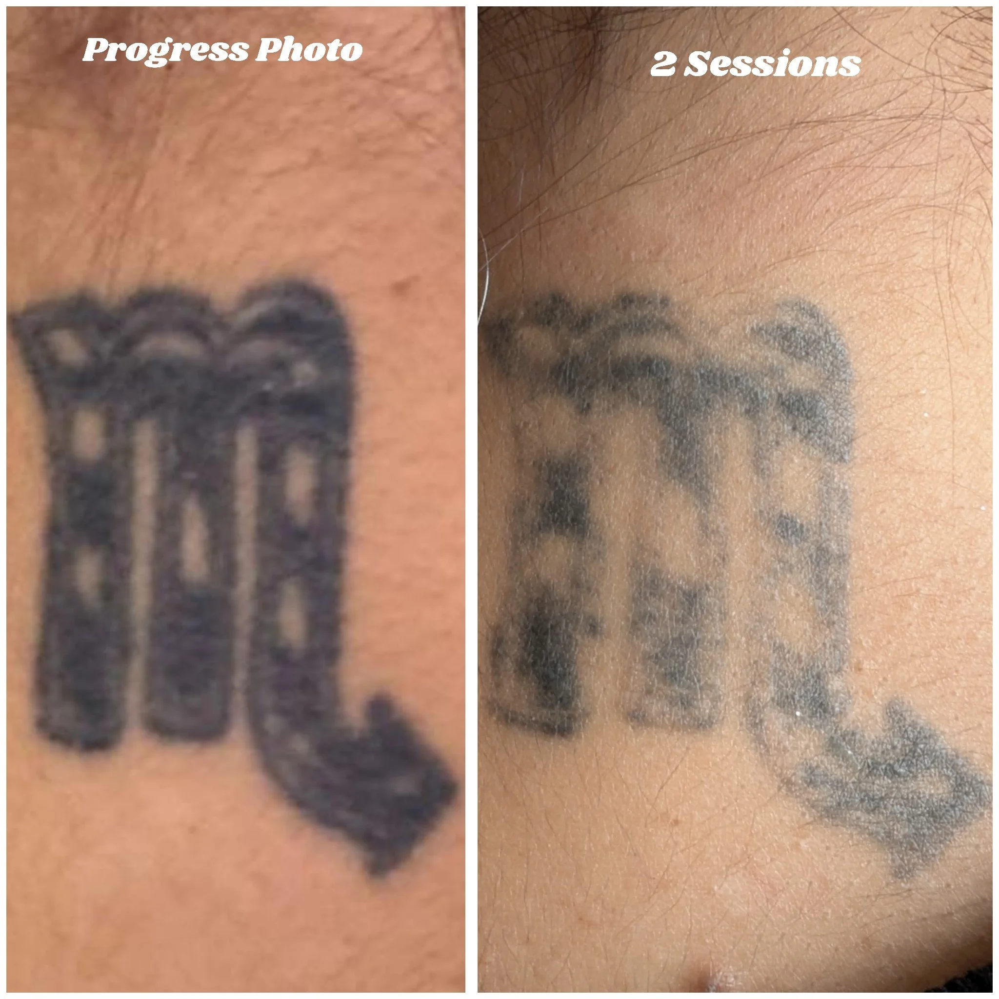 Comparison of a tattoo before and after two sessions of removal. The tattoo is black and designed with bold, ornate lettering. The left side shows the tattoo appearing darker and more defined, while the right side shows it faded and less distinct after two removal sessions.