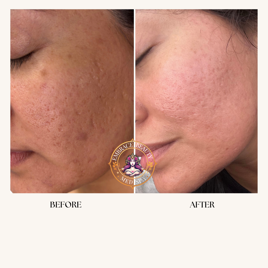 Close-up of a woman's face showing a comparison of skin before and after a skincare treatment, with improved skin texture and reduced acne scars.