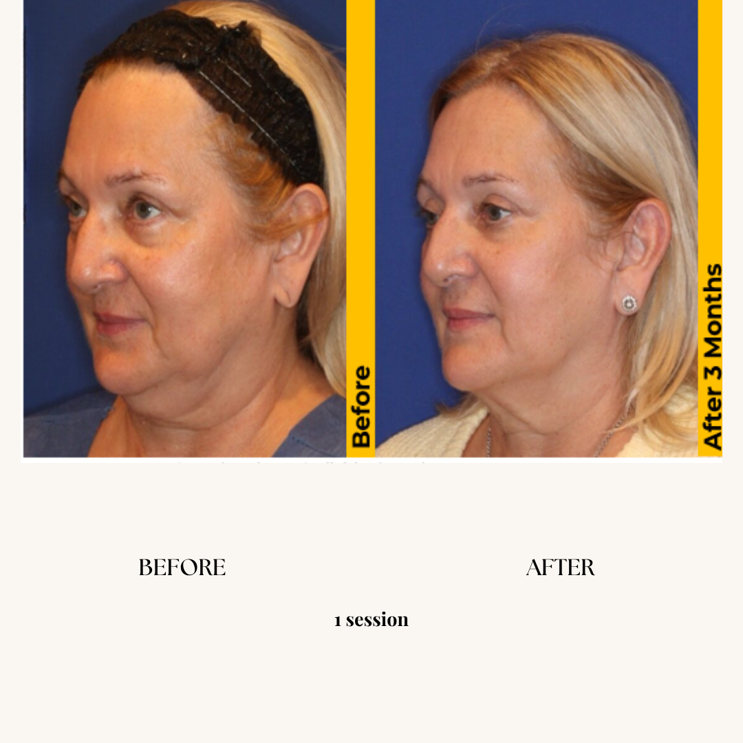 Side-by-side comparison of a woman before and after a cosmetic procedure, showing a more youthful appearance with smoother skin and fewer wrinkles after three months.