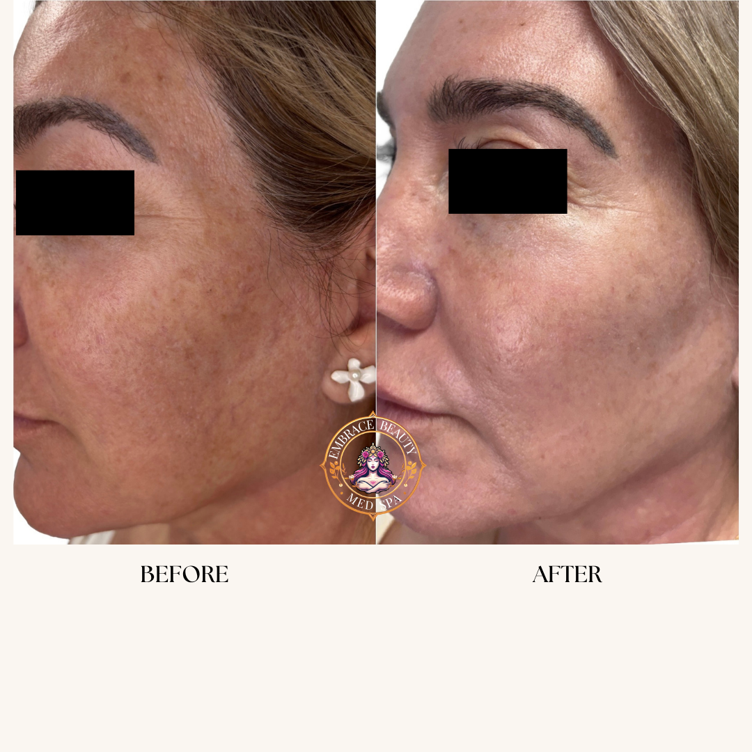 Side-by-side comparison of a woman's face showing skin improvement, with 'before' on the left and 'after' on the right, from a skincare or cosmetic treatment.