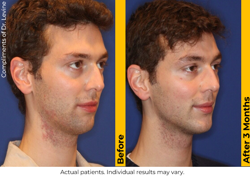 Side-by-side comparison of a young man's face before and after 3 months of treatment, showing clear skin improvements.