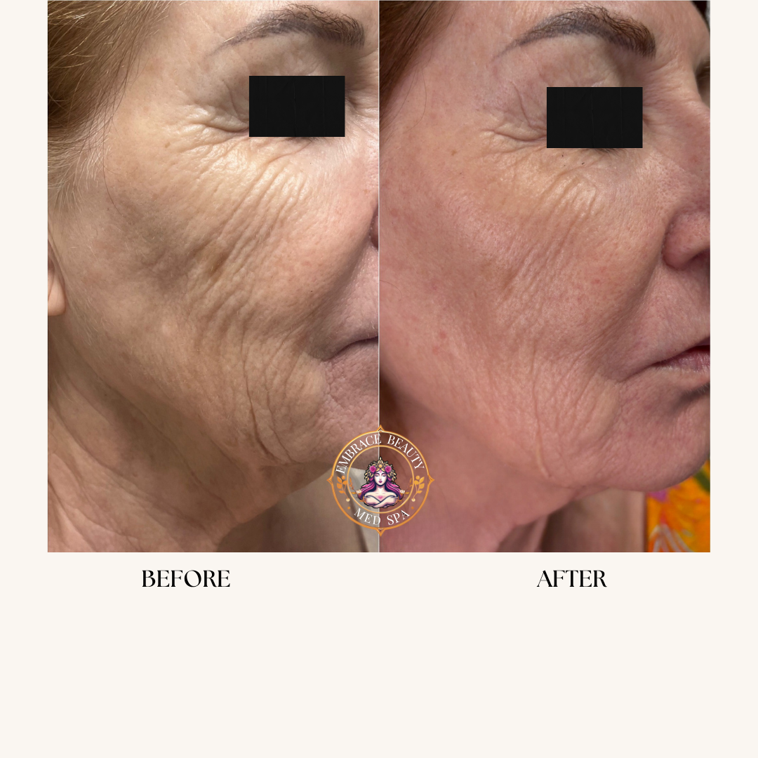 Side-by-side comparison of a woman's face before and after skincare treatment showing reduced wrinkles and smoother skin textures.