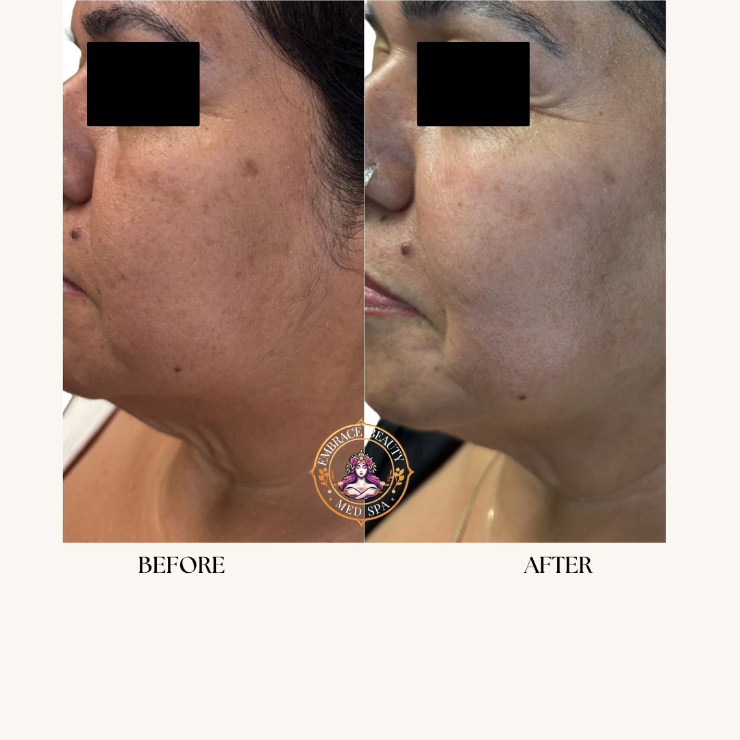 Side-by-side comparison of a woman's face showing skin improvement, with 'Before' on the left and 'After' on the right. The skin appears clearer and smoother in the after image. The logo of Embrace Beauty Med Spa is centered at the bottom.