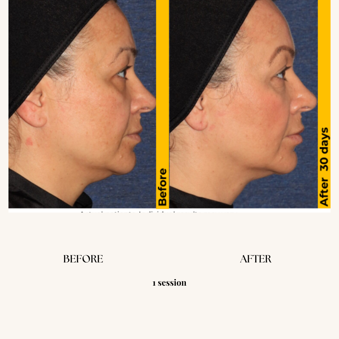 Side-by-side comparison of a woman's face before and after 30 days of treatment, showing improvement in skin texture and reduction of a double chin.