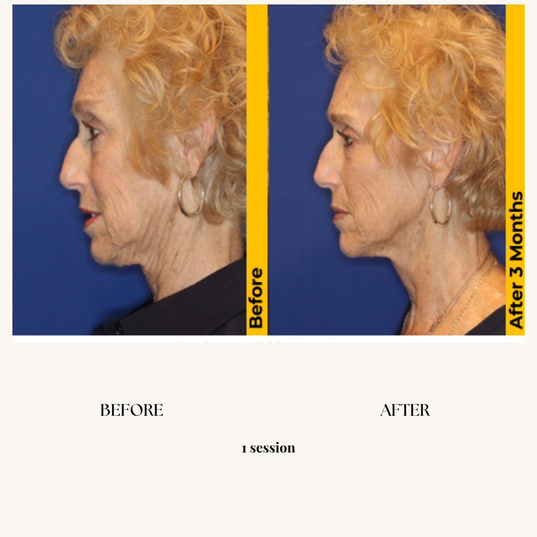 Side-by-side comparison of a mature woman's profile before and after a skin treatment, showing reduced wrinkles and improved skin tightness over three months.