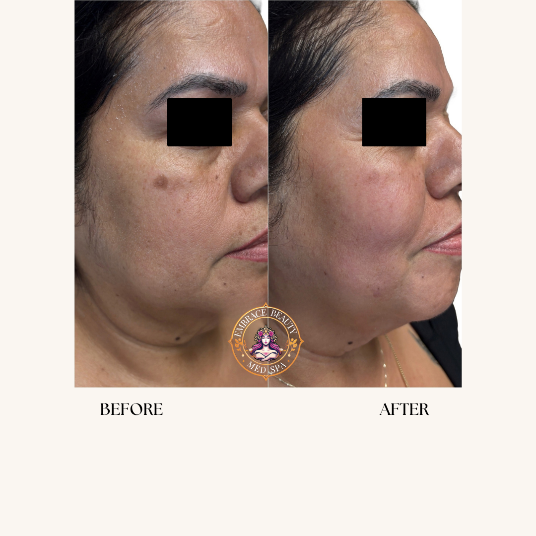 Side-by-side comparison of a woman's face before and after skincare treatment, showing improved skin clarity and reduced dark spots.