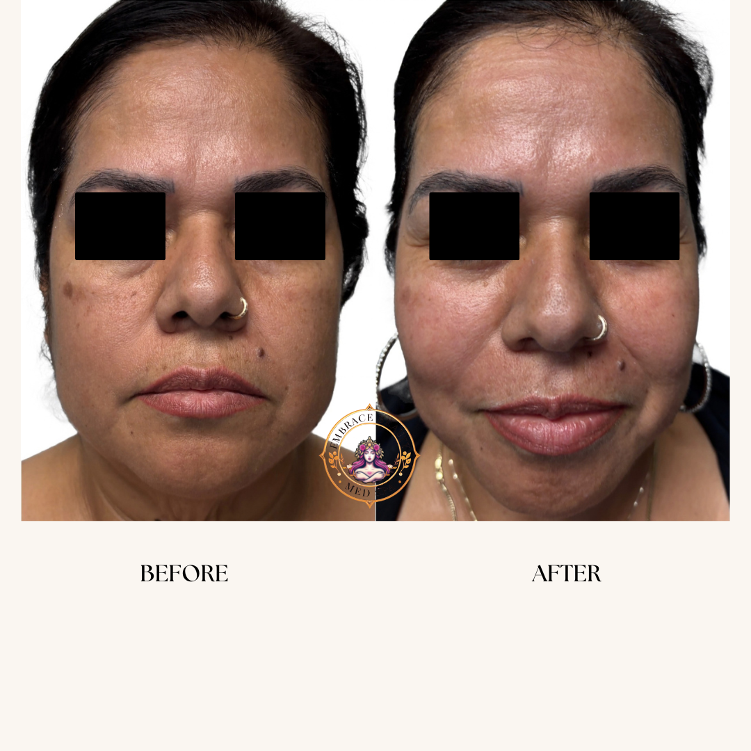Side-by-side comparison of a woman's face before and after skin treatment, showing improvements in skin texture and tone.