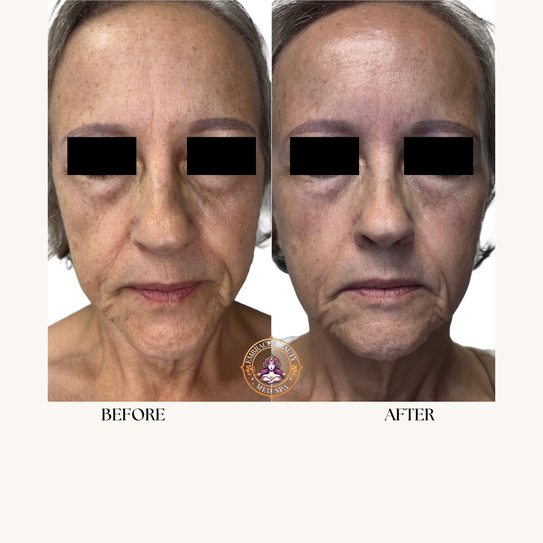 Comparison of a woman's face before and after skincare treatment, showing reduced wrinkles and smoother skin.
