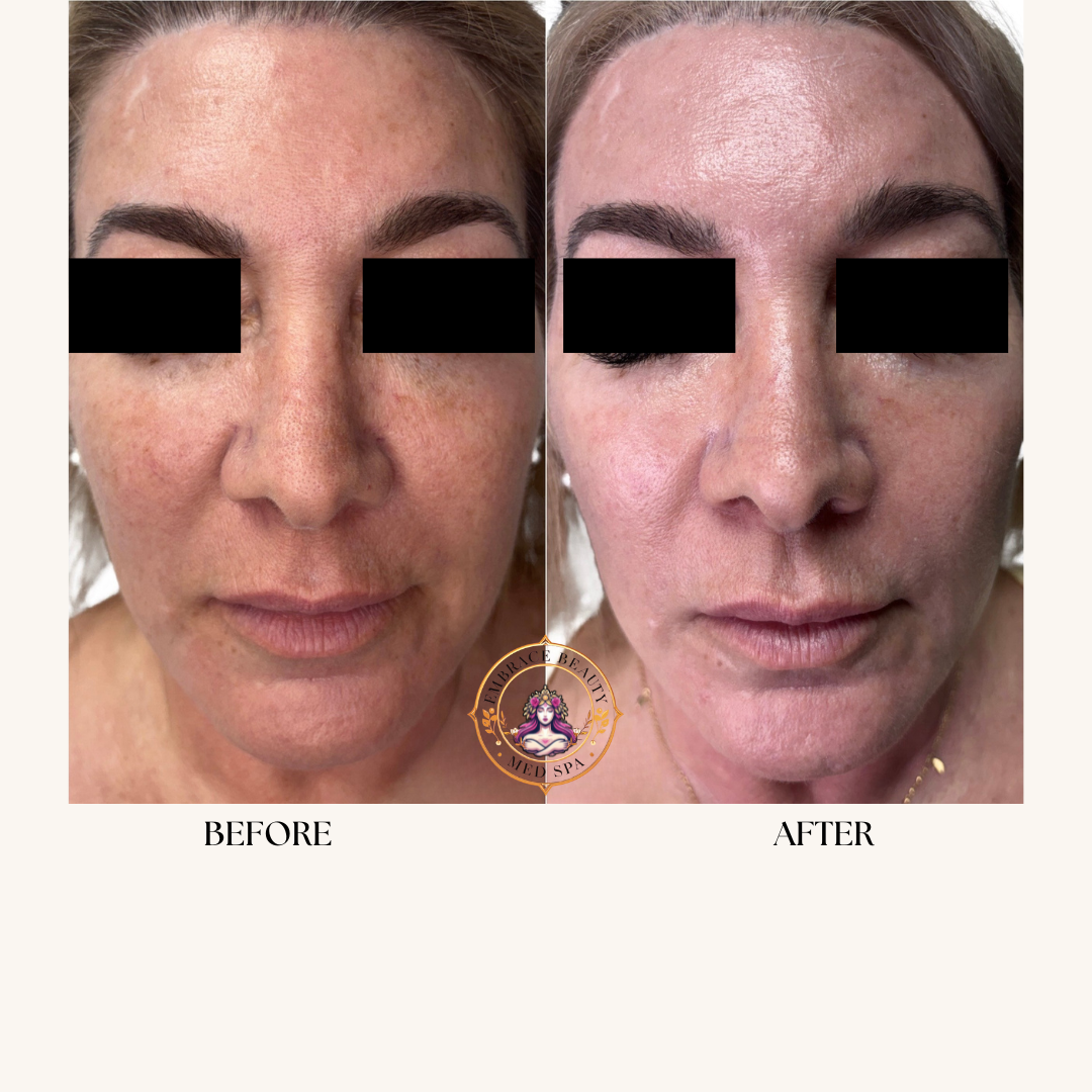 Side-by-side comparison of a woman's face before and after a skincare treatment, showing improved skin texture and brightness.