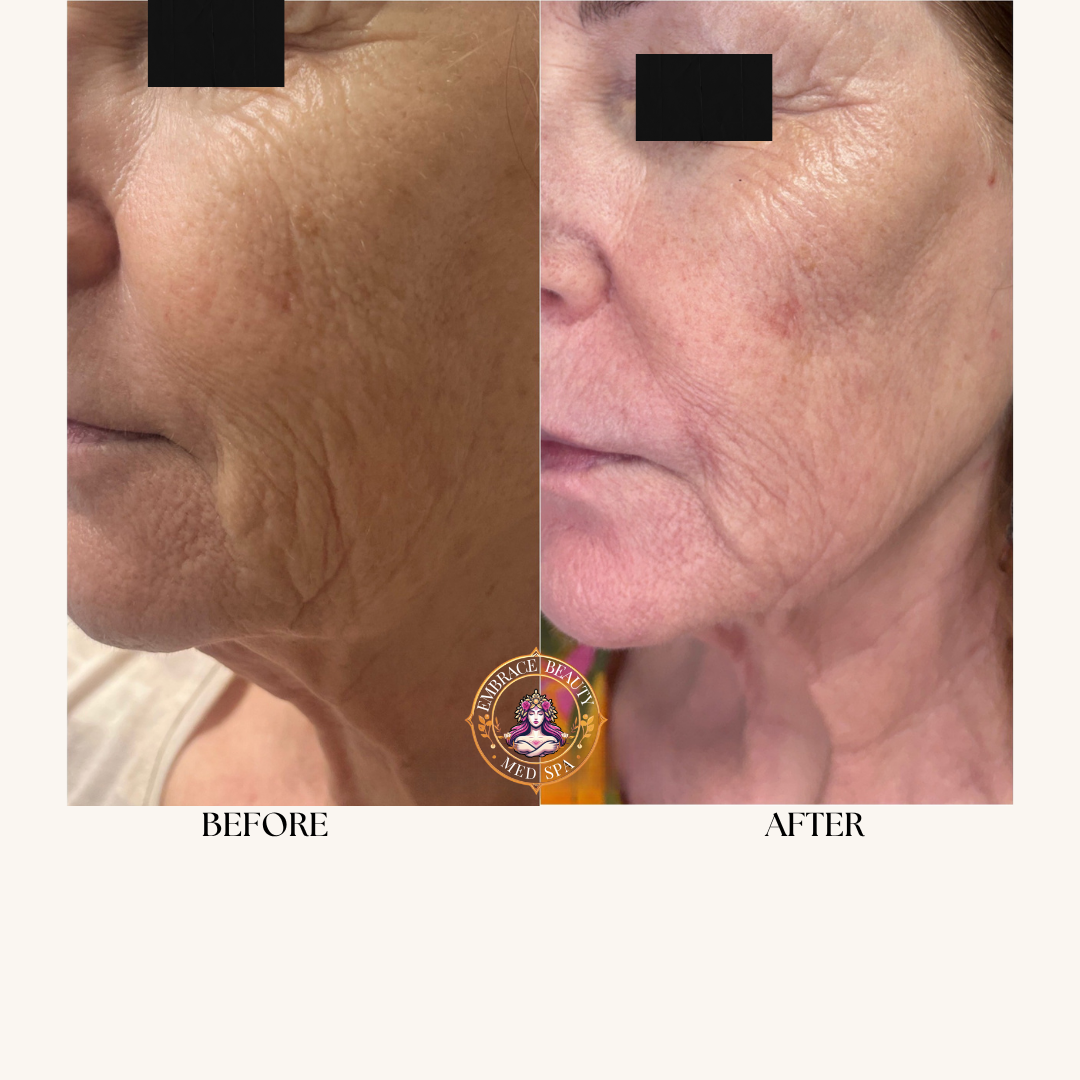 Side-by-side comparison of a person's face showing skin improvement, with the left labeled "Before" and the right labeled "After", showing smoother skin and reduced wrinkles.