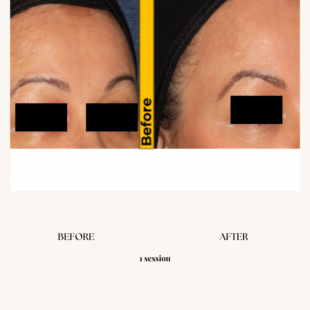 Side-by-side comparison of a woman's forehead, showing improvement in skin texture and appearance after one session. The left side is labeled "BEFORE" and the right side "AFTER".