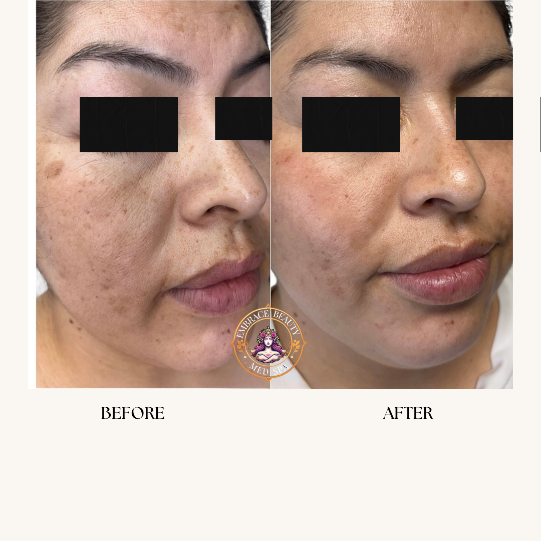 Side-by-side comparison photo of a woman's face showing the effects of skin treatment, with the left labeled 'Before' and the right labeled 'After,' highlighting improved skin texture and tone.