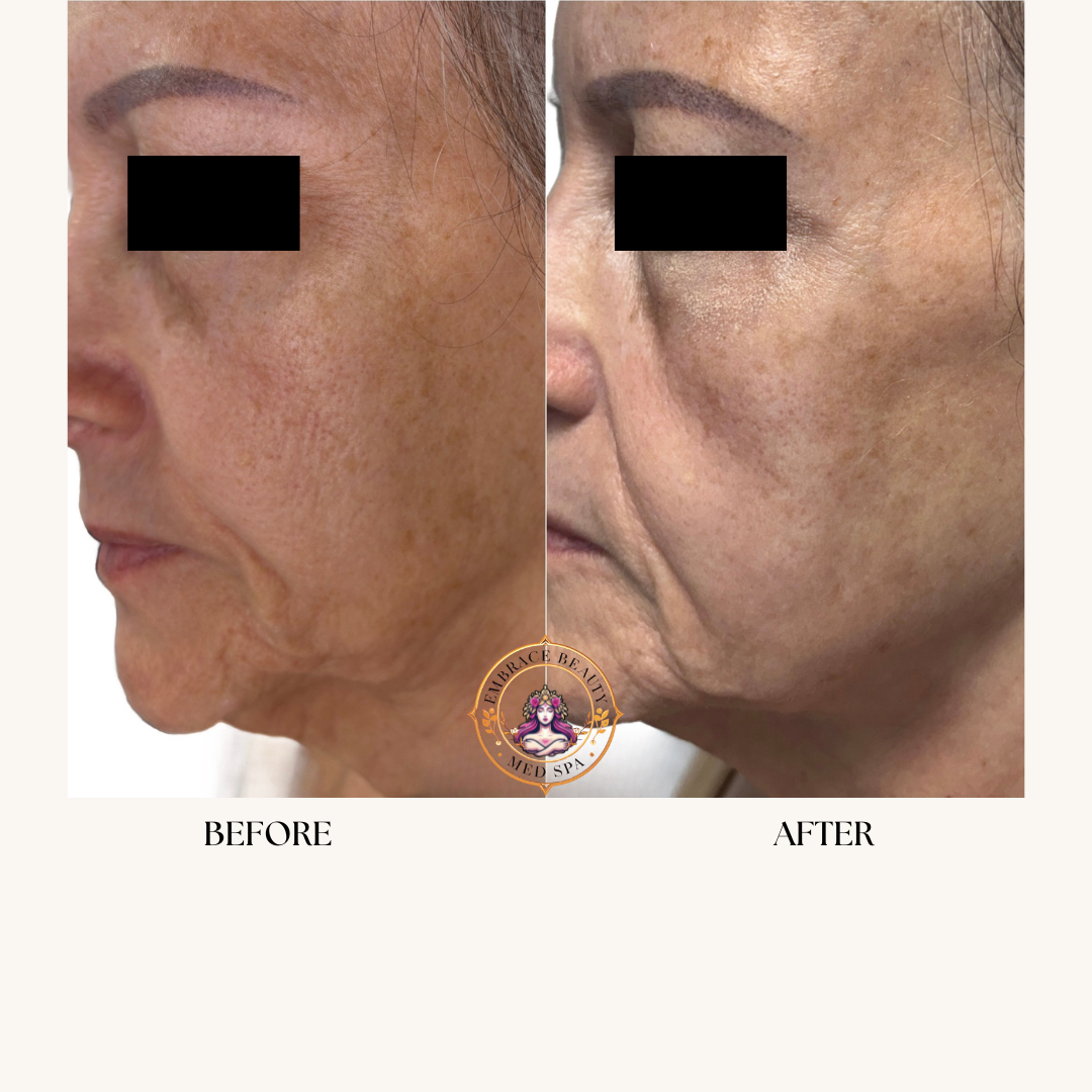 Side-by-side comparison of a woman's face showing skin improvement before and after a skincare treatment, with the 'before' on the left and 'after' on the right.