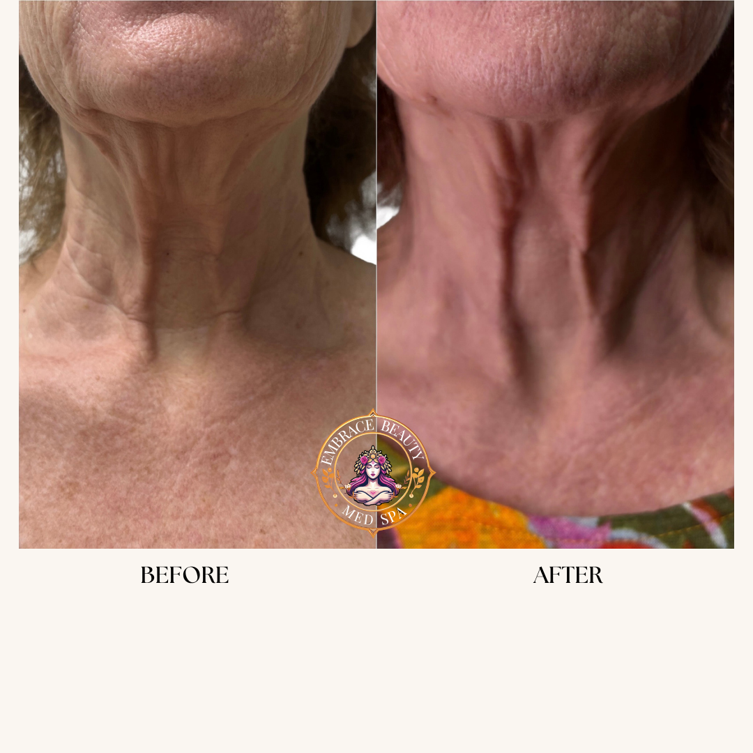 Side-by-side comparison of a woman's neck and lower face showing skin improvement; left side labeled 'Before,' right side labeled 'After.'