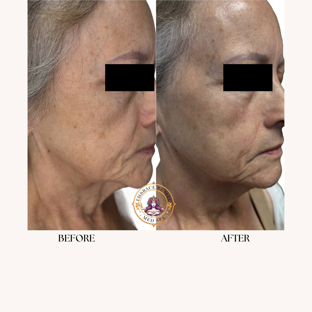 Side-by-side comparison of a woman's face showing skin improvement after treatment, with visible reduction in age spots and improved skin texture.