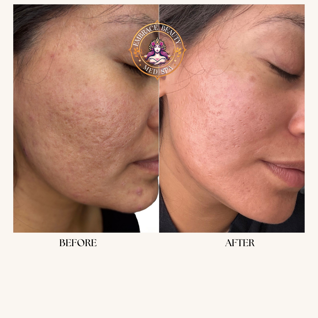 Side-by-side comparison of a woman's face showing before and after skin treatment, with visible improvement in acne scars and skin texture.