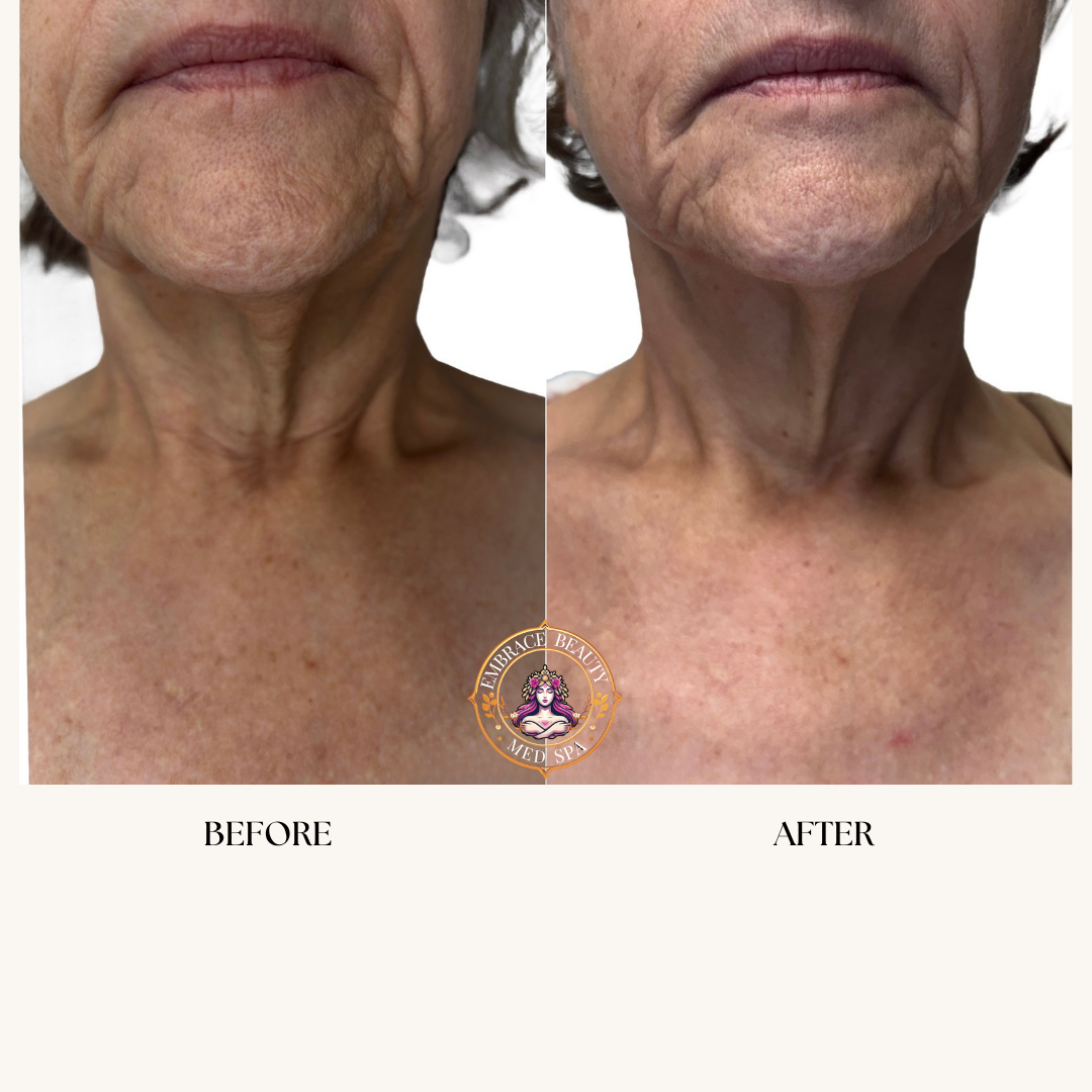 Side-by-side comparison of a woman's lower face and neck, showing skin improvements before and after a skincare treatment, with the words 'BEFORE' and 'AFTER' at the bottom.