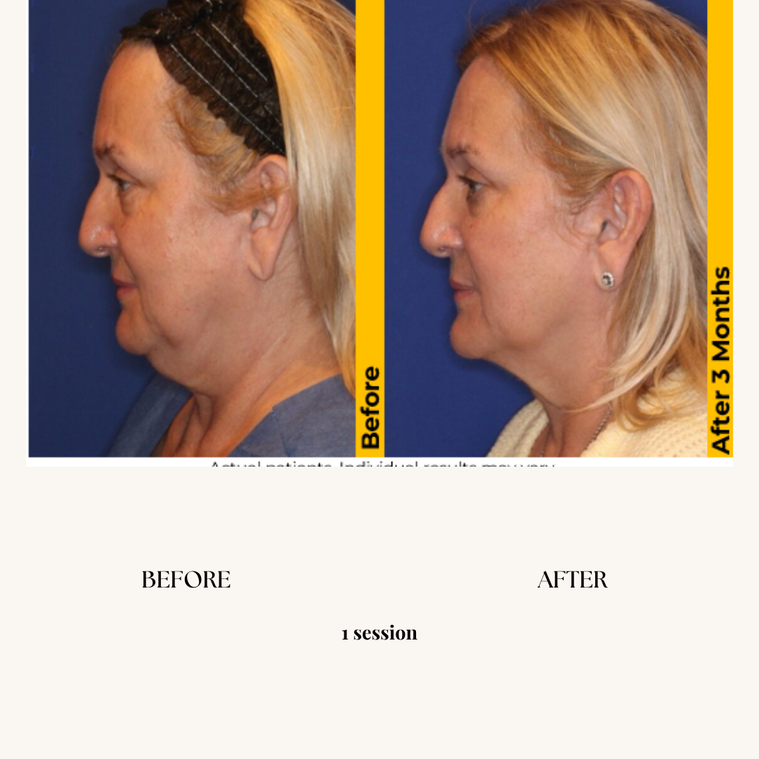 Side-by-side comparison of a woman's profile before and after cosmetic treatment. The 'before' image shows a woman with sagging skin around the neck and jawline, while the 'after' image, taken three months later, shows a more defined jawline and smoother skin.
