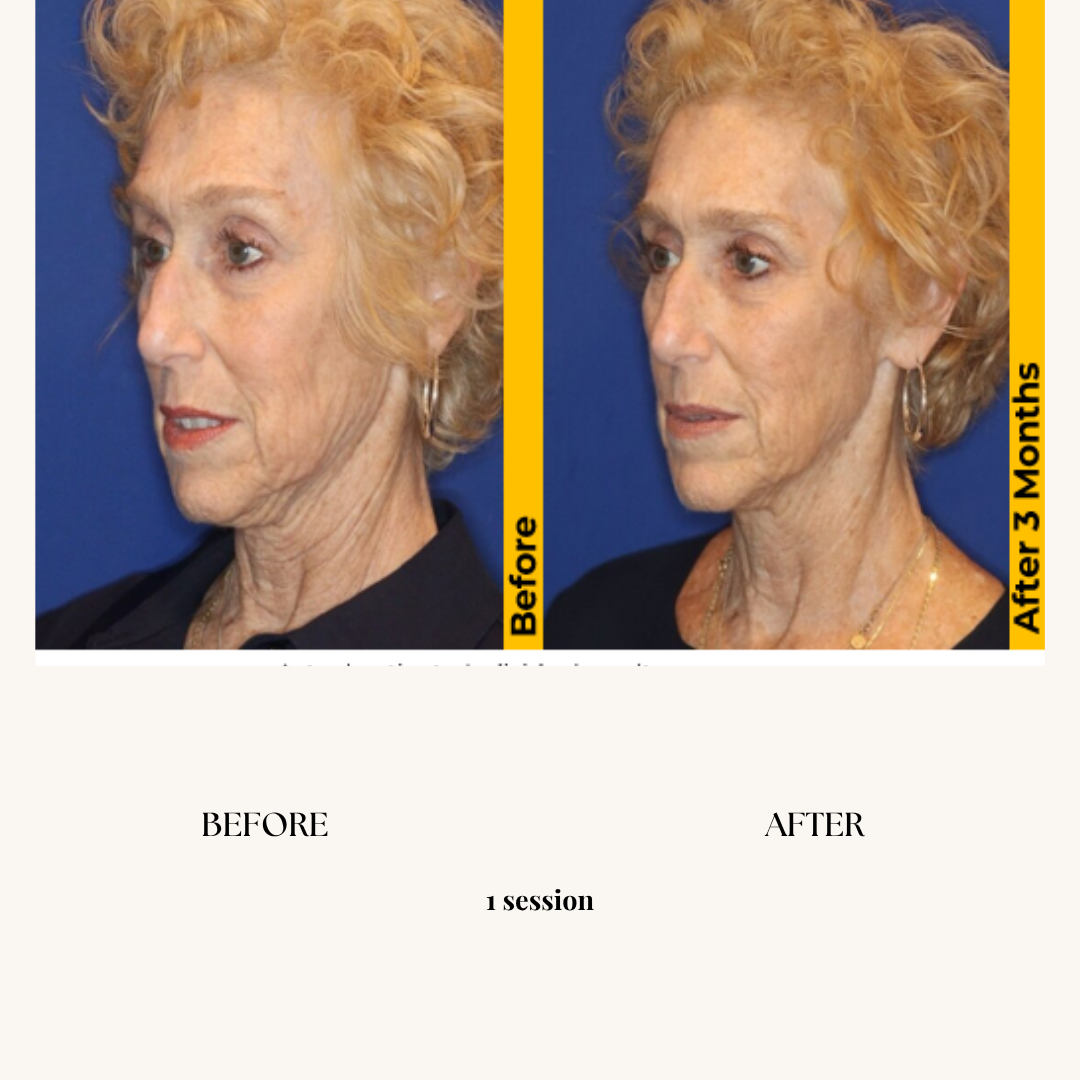 Side-by-side comparison of a woman before and after 3 months of a cosmetic treatment. The left shows her before, with visible wrinkles and sagging skin. The right shows her after the treatment, with smoother and firmer skin.