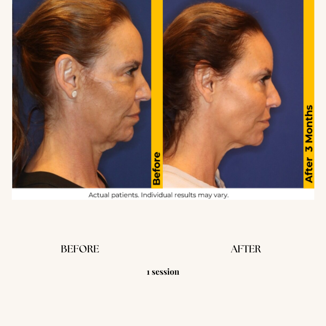 Side-by-side comparison of a woman before and after a skincare treatment, with the 'Before' photo on the left showing sagging skin and wrinkles, and the 'After' photo on the right taken three months later showing improved skin tightening.