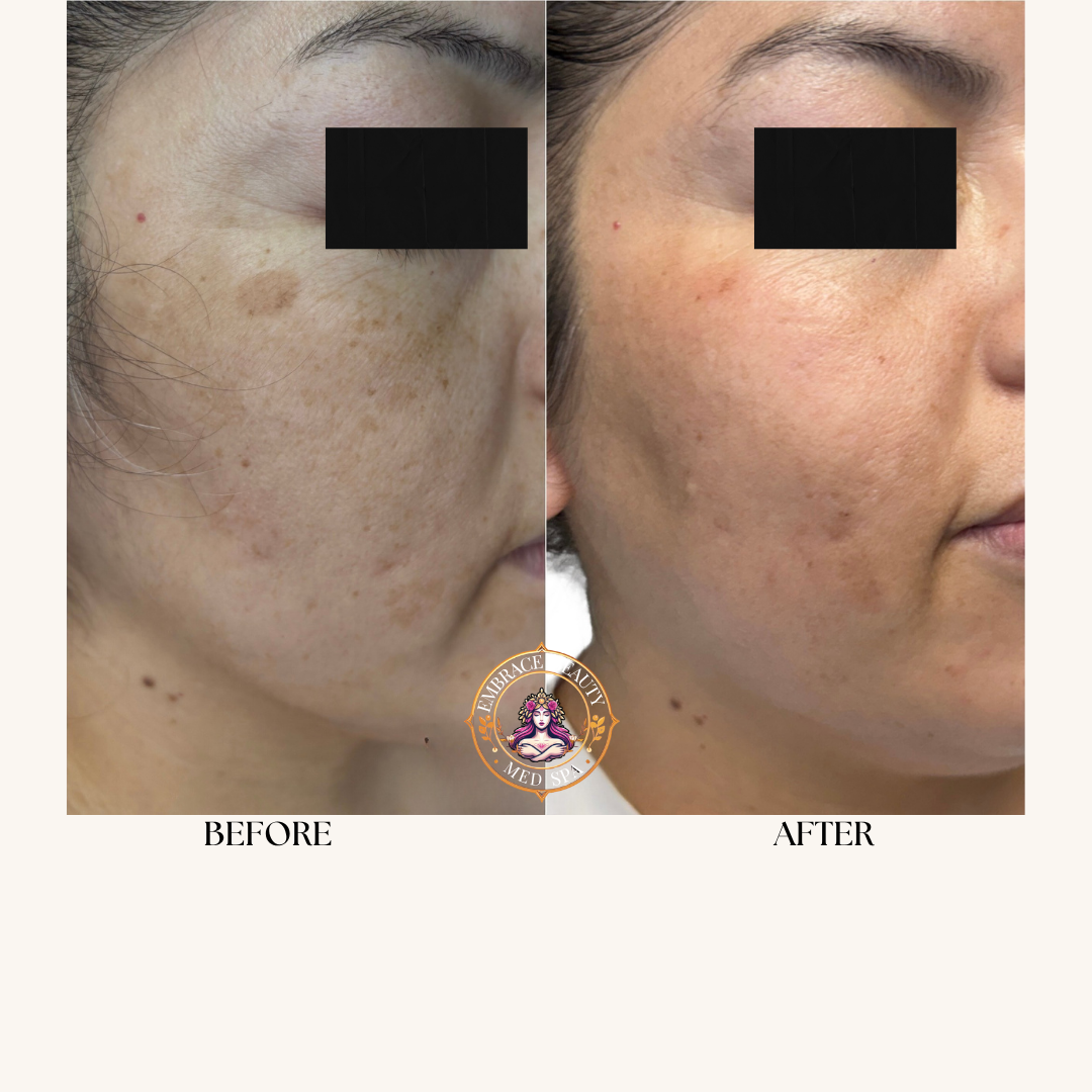 Side-by-side comparison of a woman's face showing significant improvement in skin tone and texture after skincare treatment; left image labeled 'Before' showing dark spots and uneven skin, right image labeled 'After' showing clearer, smoother skin with reduced dark spots.