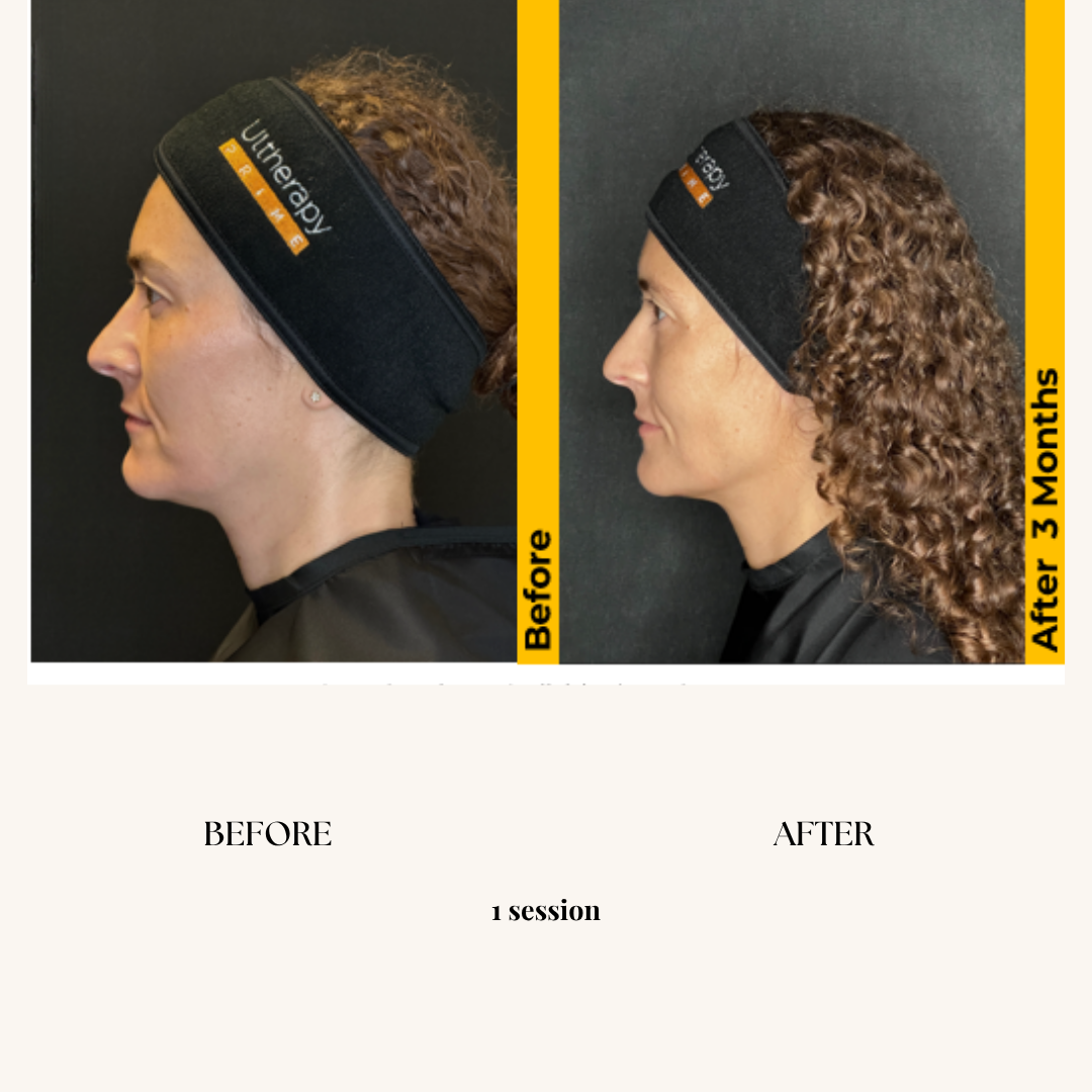 Side-by-side comparison of woman before and after treatment, showing improved posture and a reduction in neck and jawline. The first image is labeled 'Before' and the second 'After 3 Months,' taken in a professional setting with brand-specific headbands.