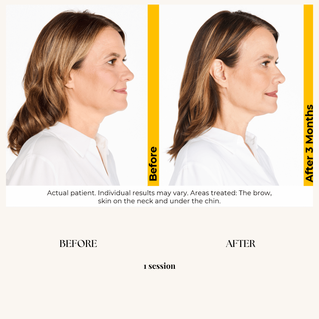 Side-by-side comparison of a woman before and after cosmetic treatment, showing improved skin and profile, with labels 'Before' and 'After 3 Months'.