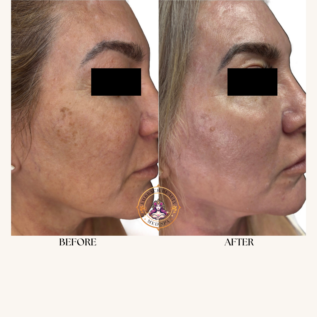 Comparison photo showing a woman's face before and after a skin treatment. The 'before' side shows uneven skin tone with dark spots and hyperpigmentation. The 'after' side shows clearer, more even-toned skin with reduced pigmentation.