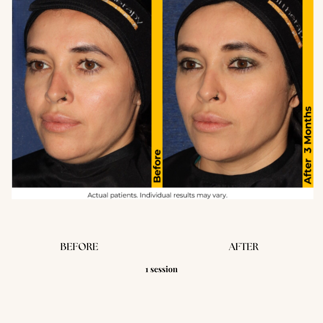 Side-by-side comparison of a woman's face before and after 3 months of a skincare session, showing clearer, more radiant skin in the after photo.