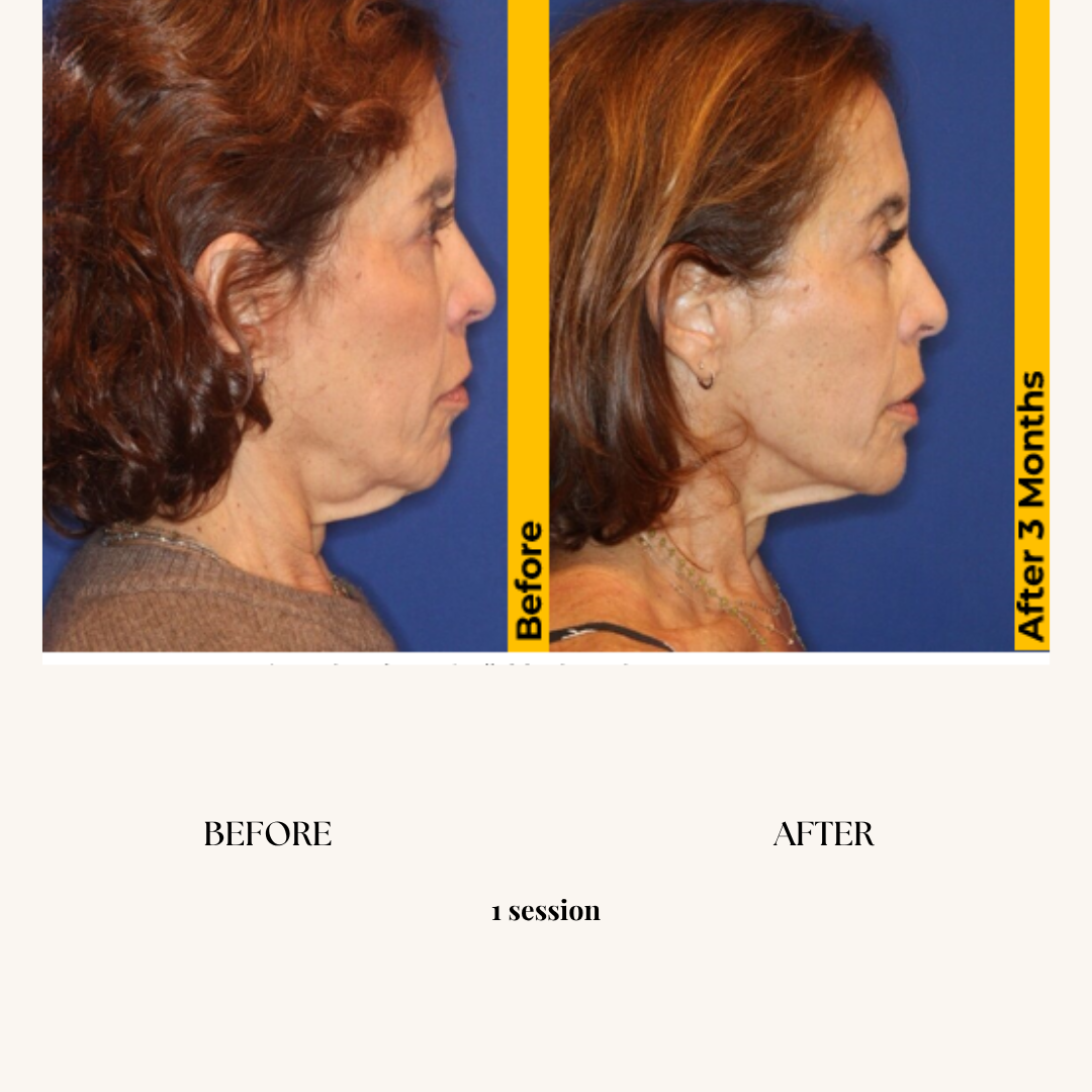 Side-by-side comparison of a woman's profile before and after a medical or cosmetic treatment, showing improvements in facial appearance over three months.