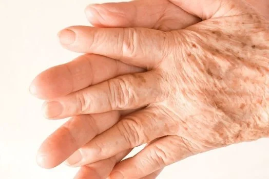 sun-damage-1-qyax0og6ubm1pl4bkyirsb5inansjmkjmh4ux8di24.jpg