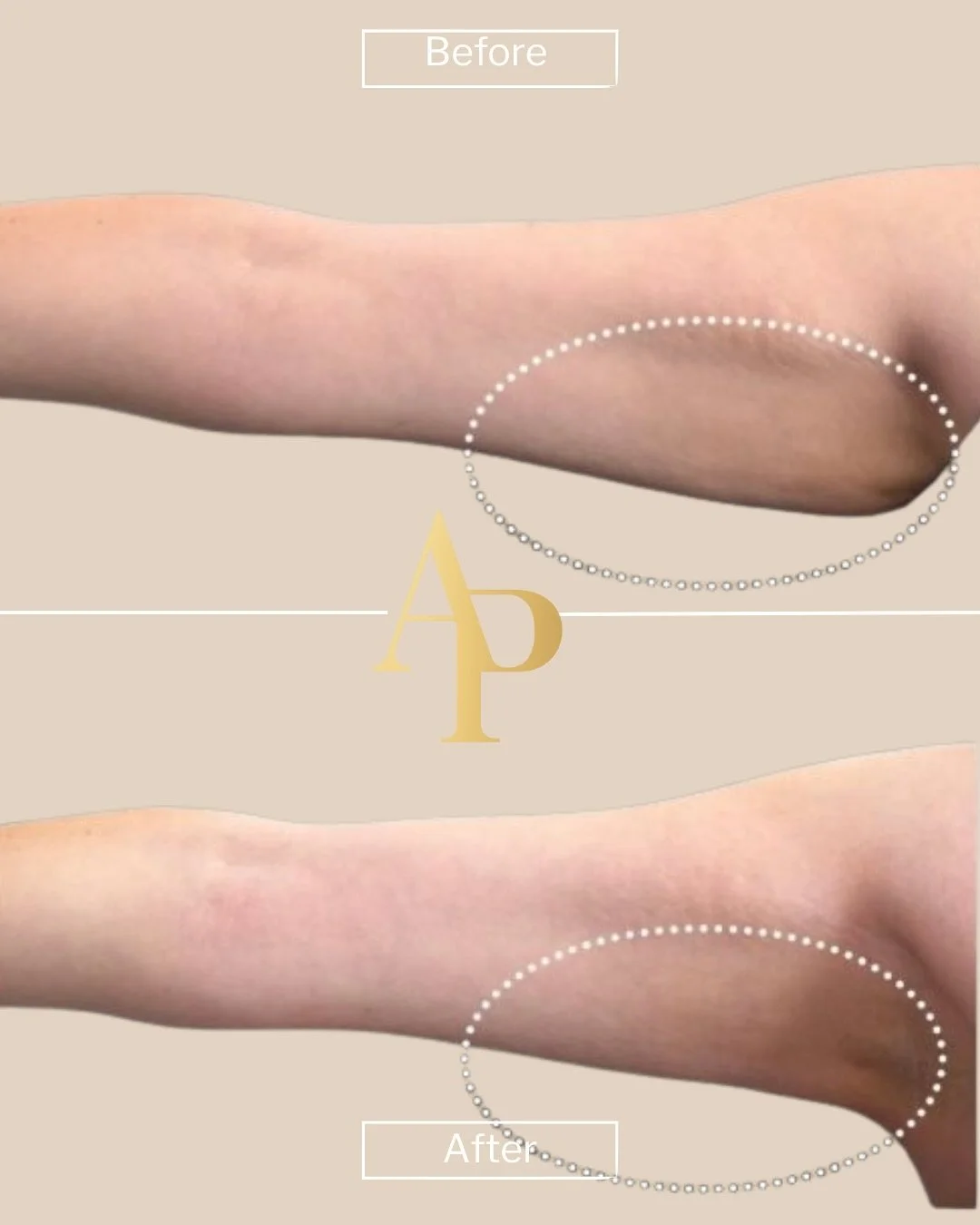 Stronger, slimmer, more defined arms ✨

Our EMSCULPT NEO treatment helps you achieve noticeable arm definition and confidence &mdash; without surgery or downtime. The difference speaks for itself!

DM us to book your consultation and start your trans