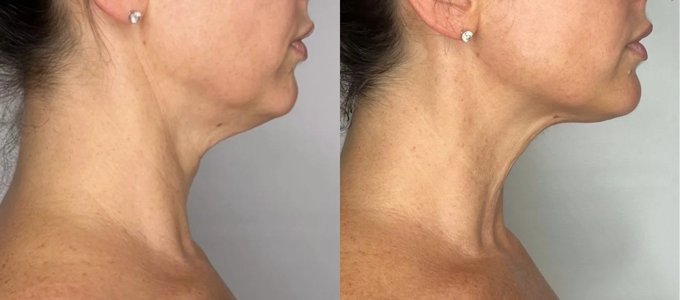 sofwave-before-after-photos-2.jpg
