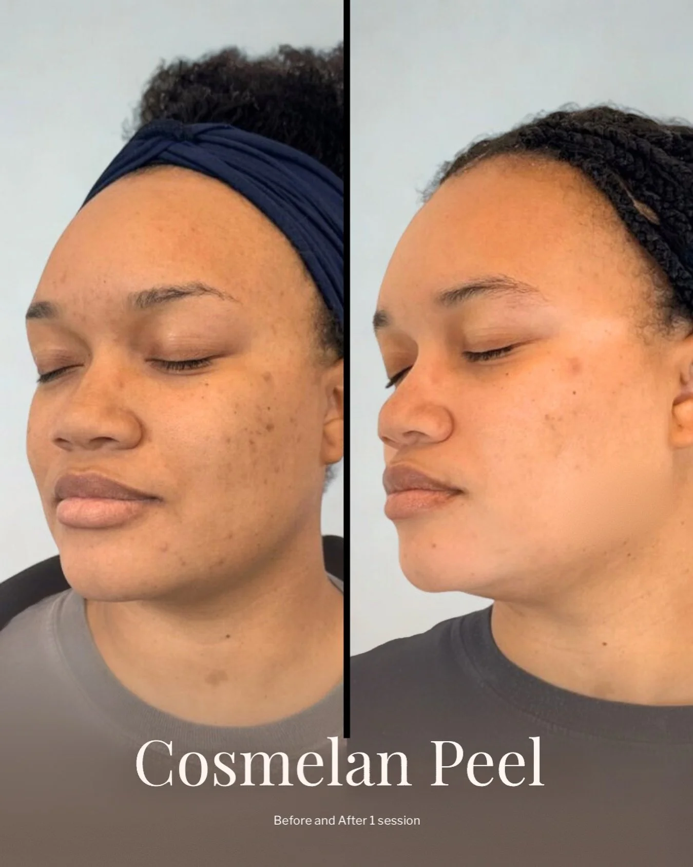 Consider this your sign!

Before and After one Cosmelan Peel &mdash; expertly curated to restore clarity, luminosity, and confidence.

Ready for your own before &amp; after moment?

📧Enquire now via the contact tab in bio &ndash; model prices get 30