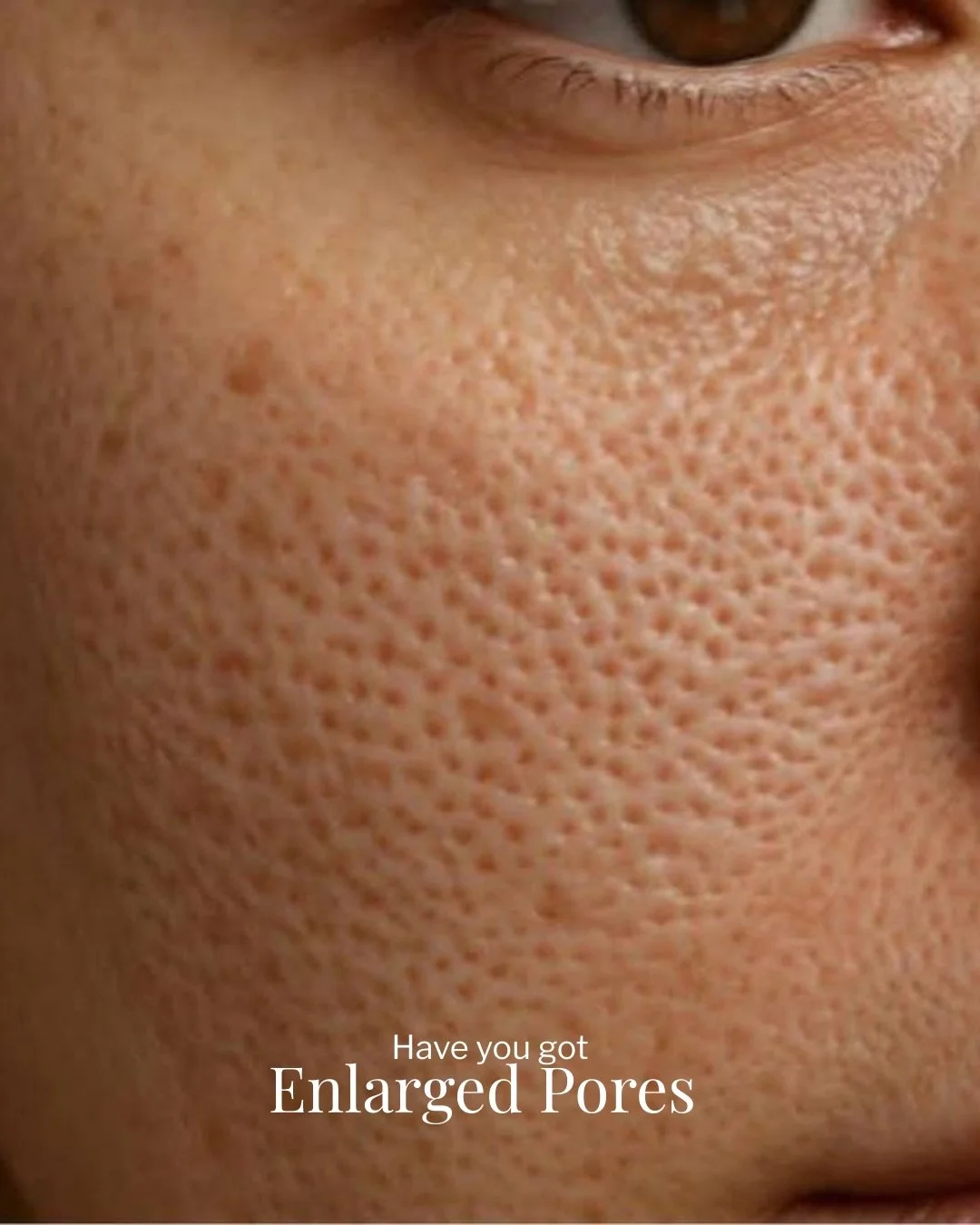 CHARACTERISTICS OF ENLARGED PORES
&bull; Pores become more noticeable when their walls stretch or lose firmness &bull; Most visible on the nose, cheeks, and forehead &bull; Often appear darker due to trapped oil and debris &bull; Skin texture may fee