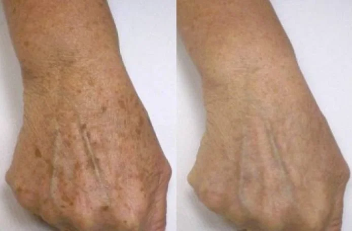 Удаление пигментных пятен лазером PicoSure.jpeg