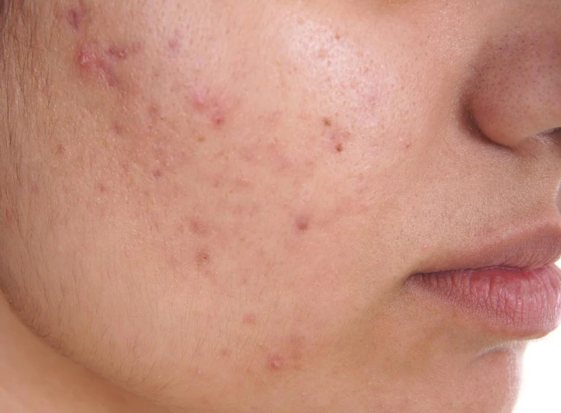 acnes.jpg
