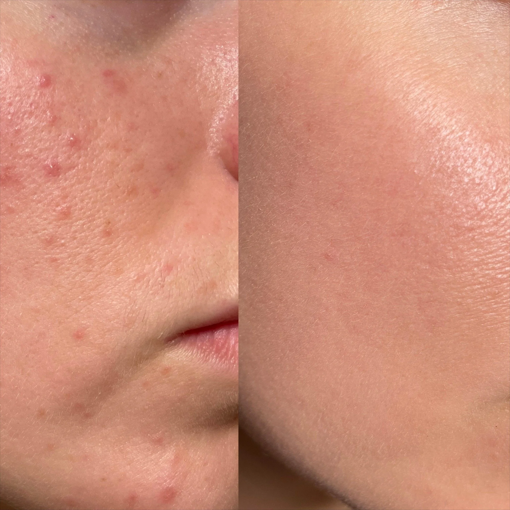 Acne Package-Basic (3 Sessions)