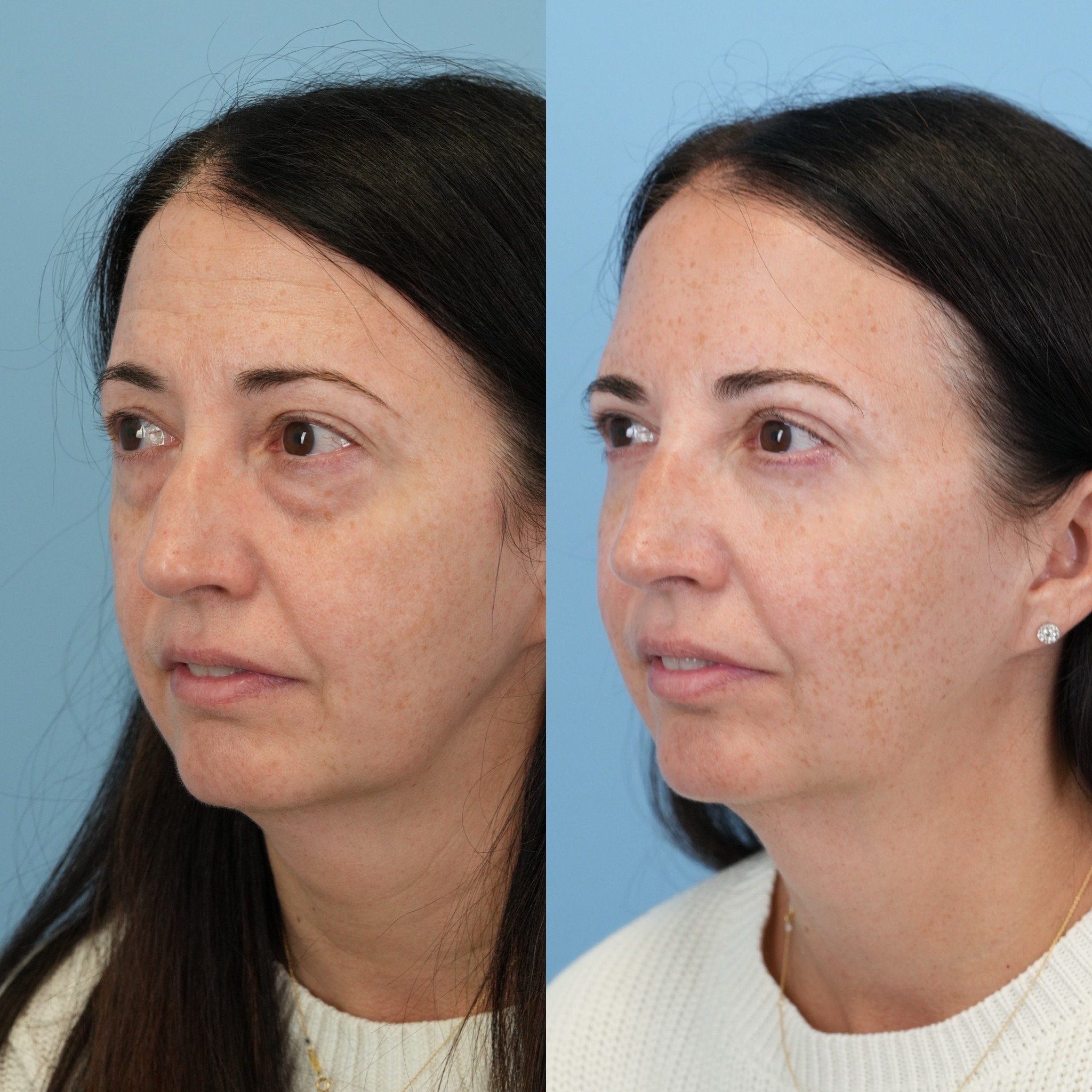 upper lower with fat grafting.JPG
