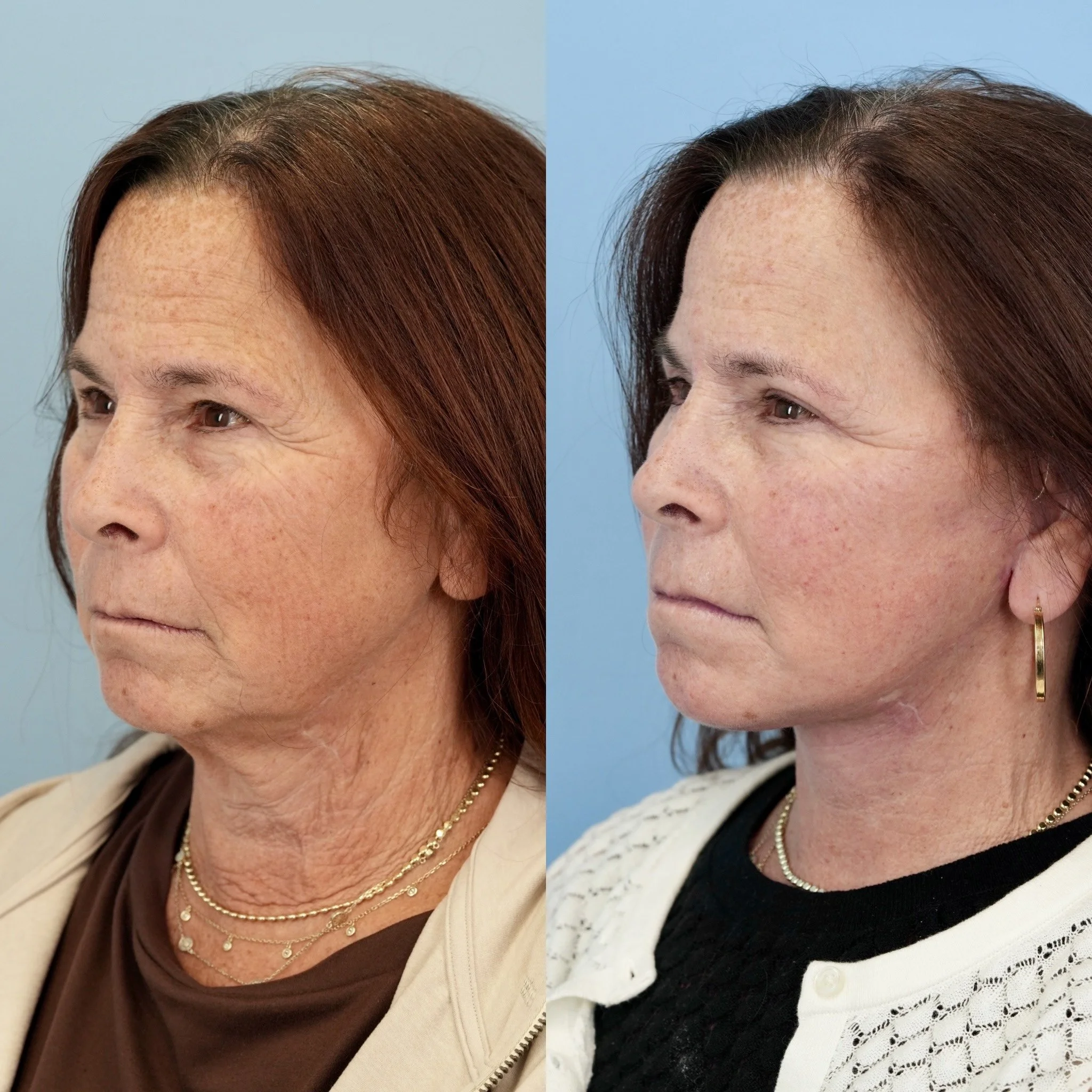 facelift.jpg